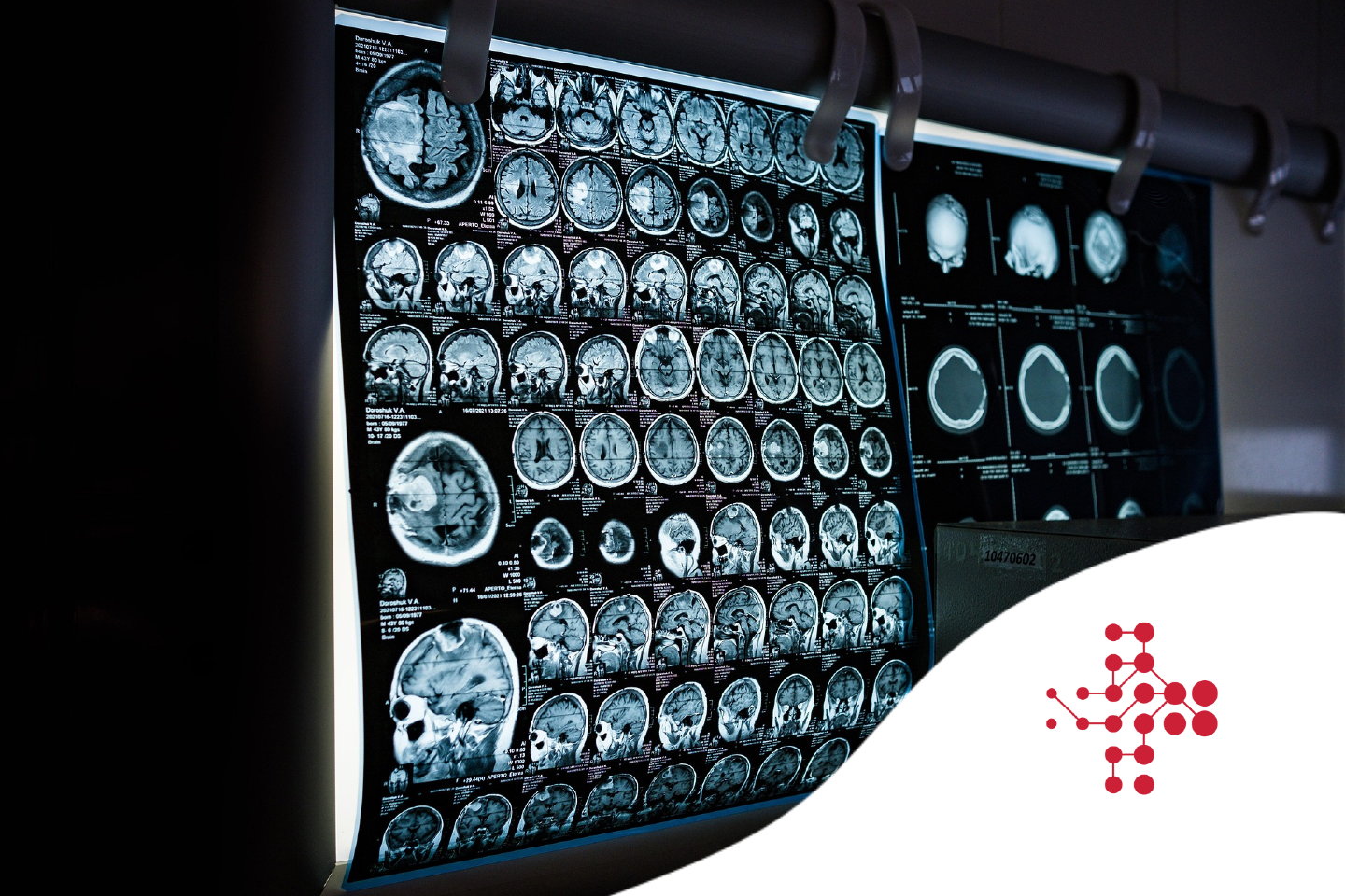 Dr. Lasso: Mozkové metastázy pod PET skenerem – nový standard je tady